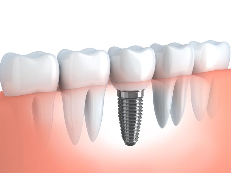 Dental Implants Roseville, CA